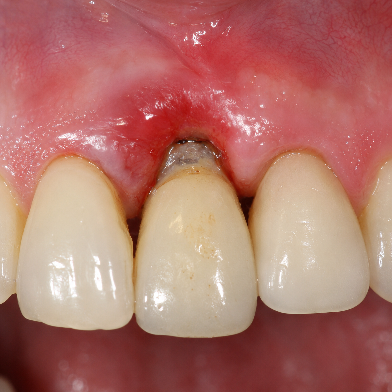 Failing dental implants to be treated with holistic dentistry