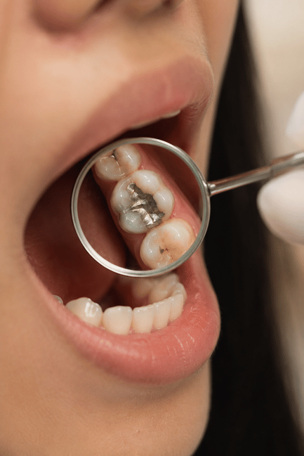 amalgam-filling amalgam-filling