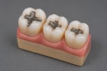 amalgam-fillings