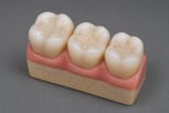 conventional-composite-filling