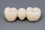 dental-bridge-1