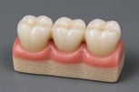 dental-crown