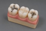 dental-fillings