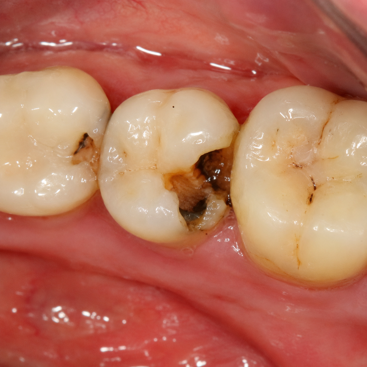 Deep dental cavities that are to be treated with inlays, onlays and BPA-free biomimetic dental fillings