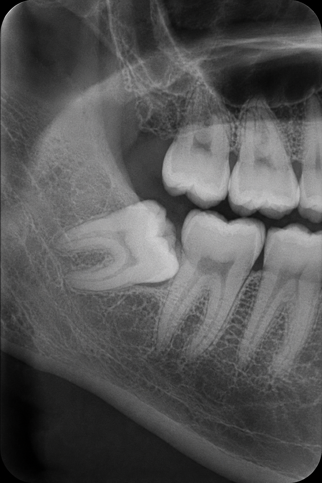 impacted-wisdom-tooth