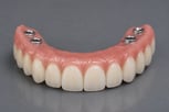 implant-supported-dentures