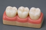 porcelain-inlays-onlays