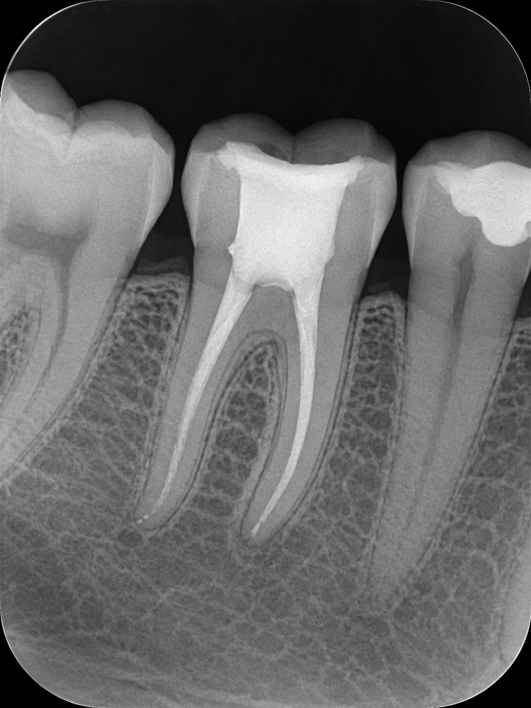 root-canal-xray