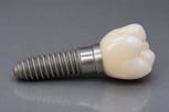 titanium-dental-implant-1