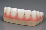veneers